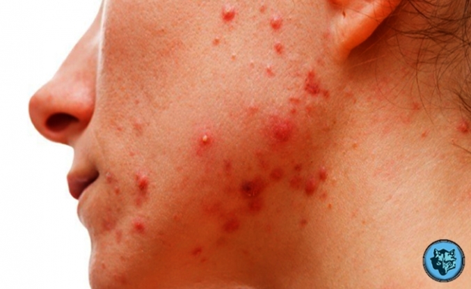 Vücudunuzdaki sivilceleri sakın sıkmayın!